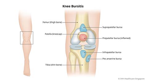 Knee Bursitis - Prepatellar & Other Types - Symptoms & Causes | Parkway ...