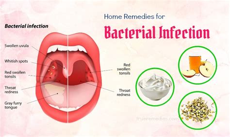 10 Best Home Remedies For Bacterial Infection In Throat & Mouth