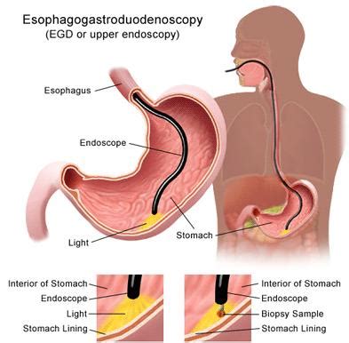 Esophagus Cancer (Esophageal Cancer) - Sign, Symptoms, and Factor ...