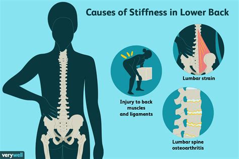 Causes of severe lower back pain