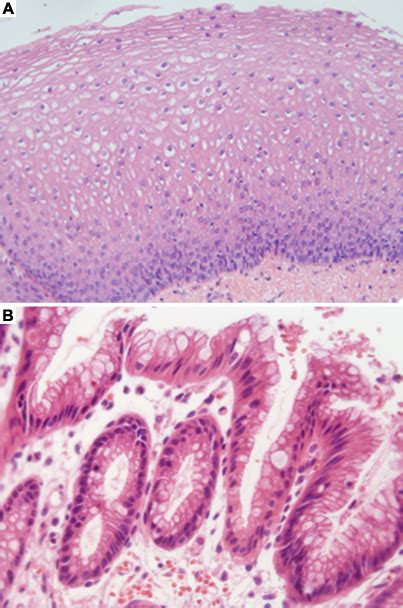 Barretts Esophagus Histology