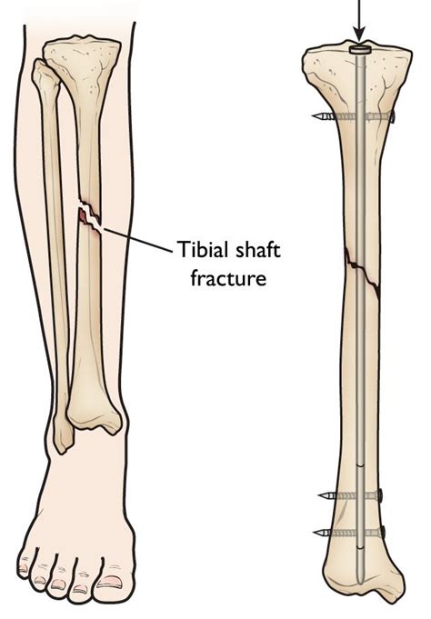 Tibia Fracture Physiotherapy Exercises