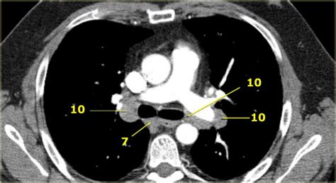 The Radiology Assistant : Mediastinal Lymph Node Map