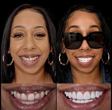 Gum Lift and Porcelain Veneers Celebrities With Veneers, Gum Removal ...