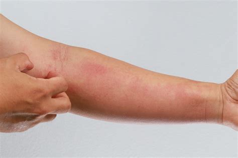 Seasonal Rash On Arms At Joseph Kinney Blog