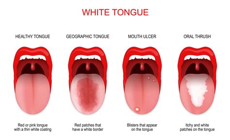 What Causes White Spots On The Mouth - Infoupdate.org