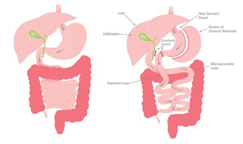 Duodenal Switch Surgery - Heartland Weight Loss Clinic