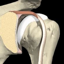 MRI Results = SLAP Tear (Shoulder Labrum)