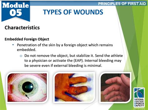 11-types-of-wounds4 – National Center for Sports Safety