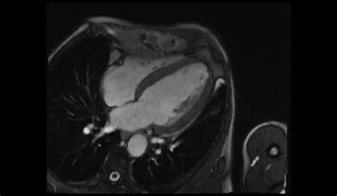 Compressed Sensing (CS) MRI