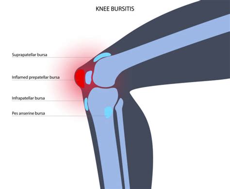 Prepatellar bursitis - Primal Physiotherapy