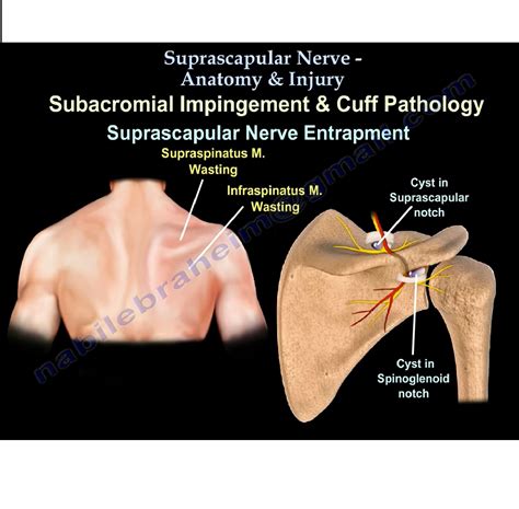 Suprascapular Nerve Anatomy Orthopaedicprinciples Com | sexiezpix Web Porn