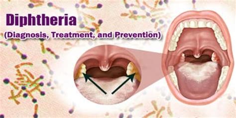 Diphtheria (Diagnosis, Treatment, and Prevention) - Assignment Point