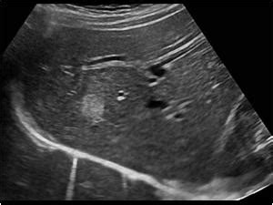 Abdomen and retroperitoneum | 1.1 Liver : Case 1.1.2 Hemangiomas ...