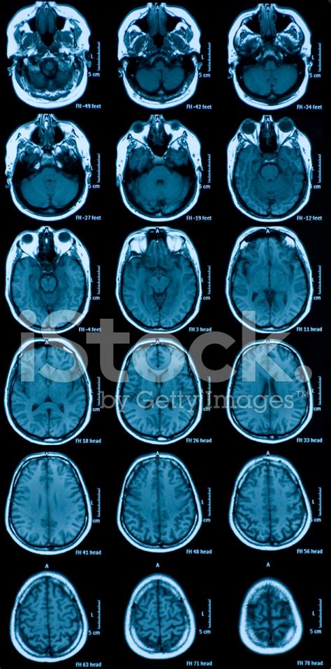 Mri Scan Of Brain Stock Photo | Royalty-Free | FreeImages