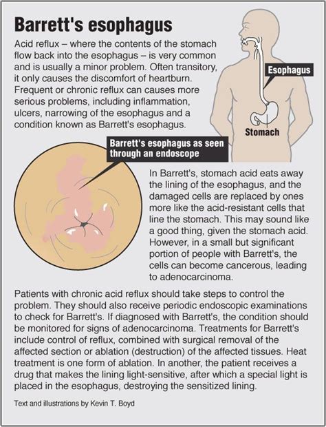 Understanding Barrett's Esophagus | Health Infographics