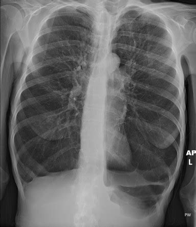 Emphysema Radiology