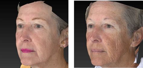 Laser Wrinkle Reduction Before & After 04 | VIP