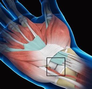 Wrist Ligament Reconstruction NSW | Wrist Ligament Injury NSW