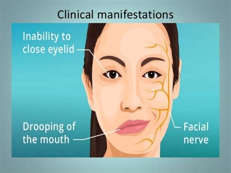 5th Cranial Nerve Palsy