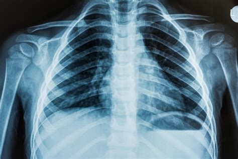 X-Rays: MedlinePlus