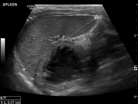 Normal ultrasound of the spleen (maximum longitudinal length ...