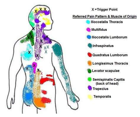 Trapezius Trigger Points Referred Pain