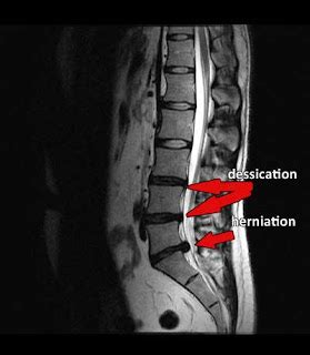 L5-S1 Disc Herniation & Dessication - What is it?