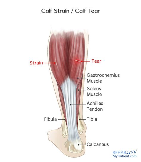 Calf Strain / Calf Tear | Rehab My Patient