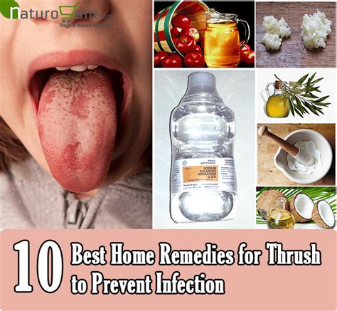 10 Best Home Remedies for Thrush to Prevent Infection