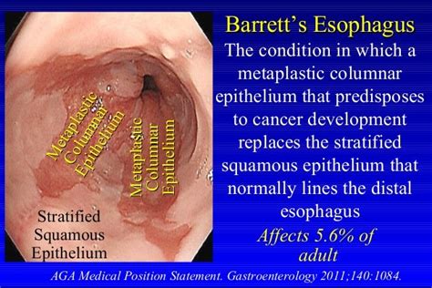 Stages Of Barrett's Esophagus