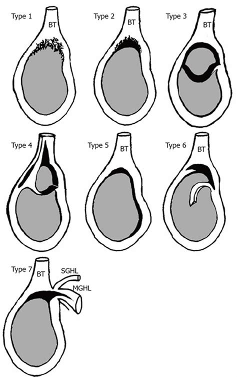 Shoulder Labrum Tear Icd 10