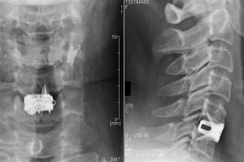 Anterior Cervical Discectomy Fusion In NJ | Comprehensive Spine Care