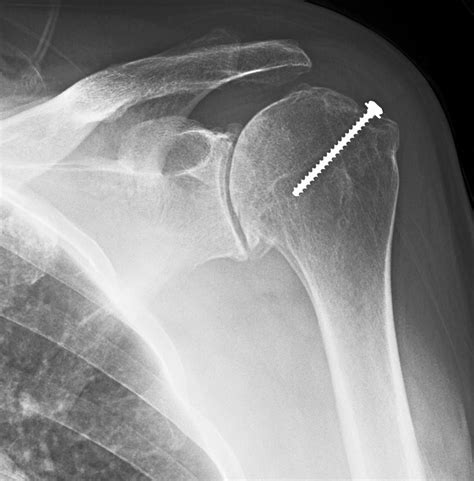 UW Shoulder and Elbow Academy: How bad is the shoulder arthritis on x-ray?