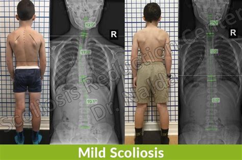 Mild Scoliosis - Symptoms, Treatment, and Surgery