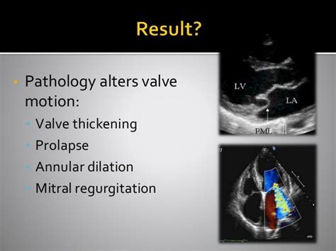 Cardiology - Myxomatous Mitral Valve Degeneration: What's New? By Rit…