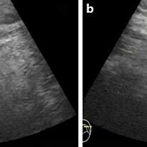 Transoral ultrasound findings. a Ultrasound showed the retropharyngeal ...