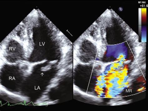 Two-dimensional transthoracic echocardiography demonstrates a ...