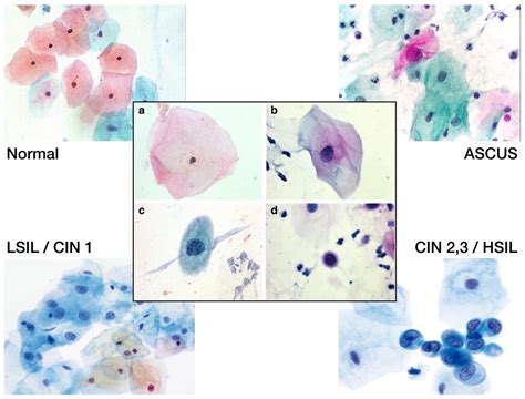 ASCUS PAP Smear & HPV - Anthony Siow