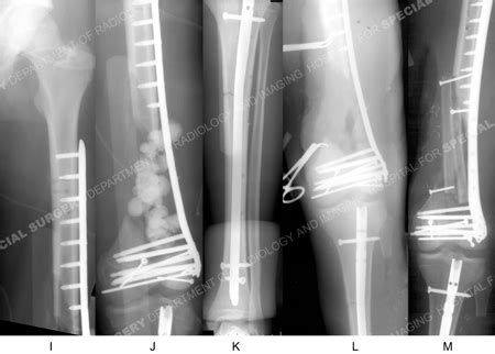 Complex Fractures - Orthopedic Trauma Service