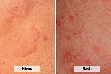 Hives vs. Rash: Here's How to Tell the Difference | The Healthy