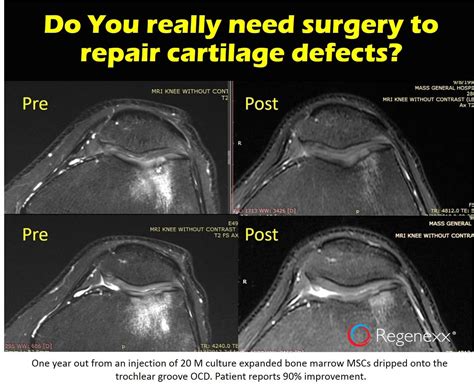 What's Possible with Stem Cells Cartilage Regrowth - Regenexx Blog