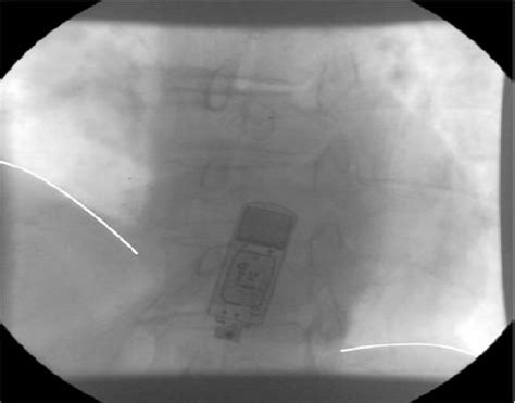 Fluoroscopic demonstration of right-sided phrenic nerve palsy following ...