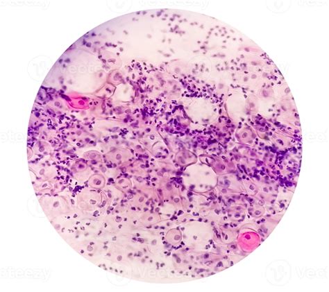 Paps smear. Microscopic examination of pap smear showing inflammatory ...