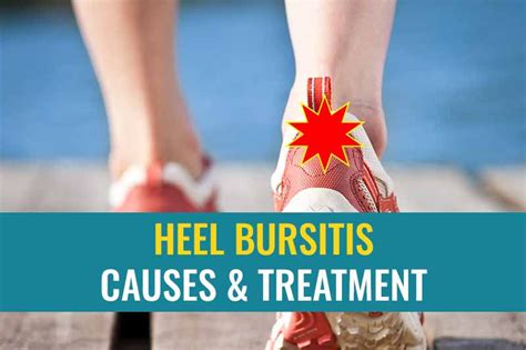 Heel bursitis: Causes and treatment | Treat My Achilles