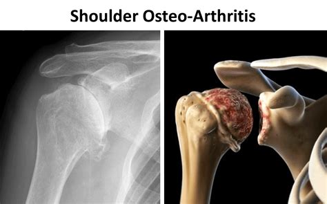 Shoulder Support For Rheumatoid Arthritis at Hazel Becker blog