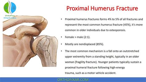 Proximal Humerus Fracture • Easy Explained | OrthoFixar 2025