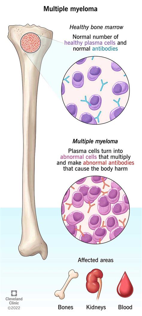 Multiple Myeloma: Symptoms, What It Is, Prognosis & Treatment