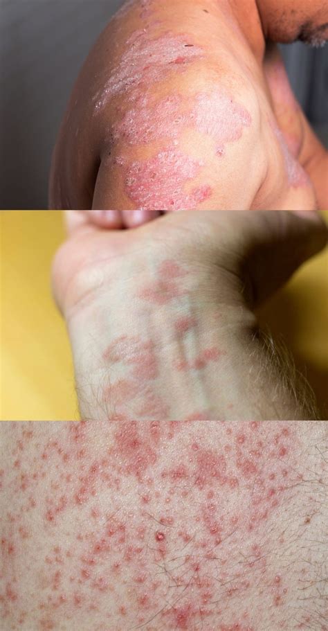 Penyakit Kulit Psoriasis – newstempo