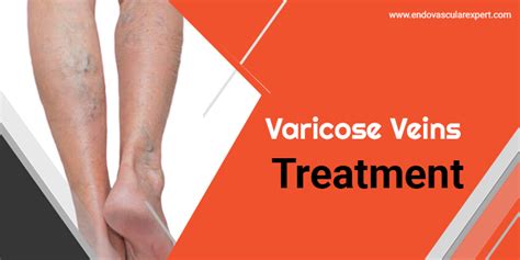 Varicose Veins Treatment in Jaipur by Dr. Nikhil Bansal